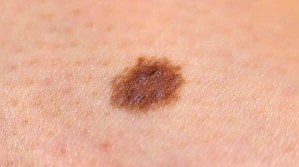 Recognizing pigment changes and spread around moles