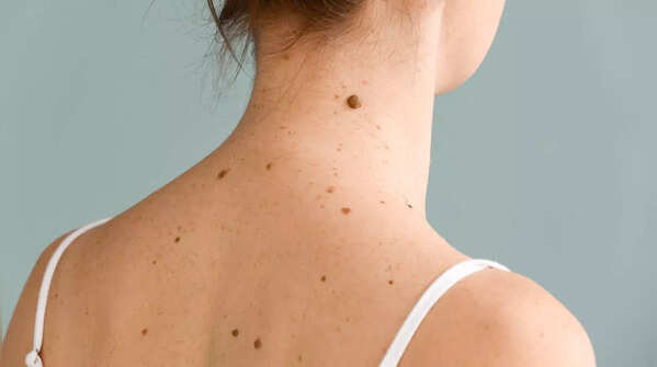 Spotting new and unusual skin growths