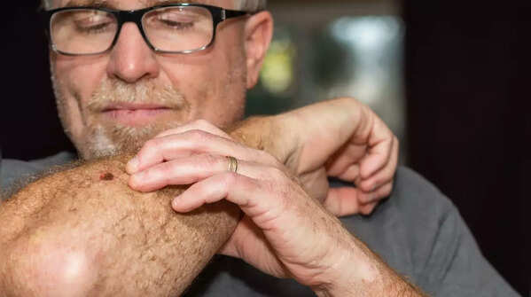Understanding the ABCDE rule for mole assessment