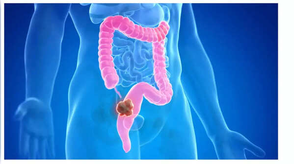 Rapid weight loss can be a sign of colon cancer