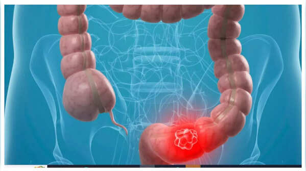 Aching stomach as a sign of colon cancer