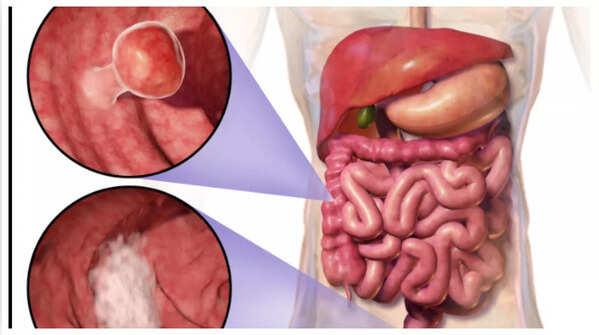 Close-up of blood in stool