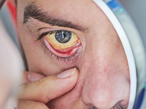 Jaundice: Yellowing of eyes and skin signals potential liver dysfunction.