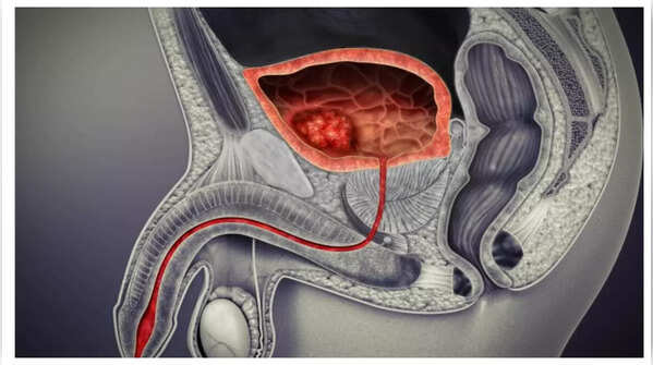 Subtle changes in urine color can indicate bladder cancer.